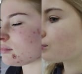 Акція до 1 вересня Врач-косметолог Екатерина Киев