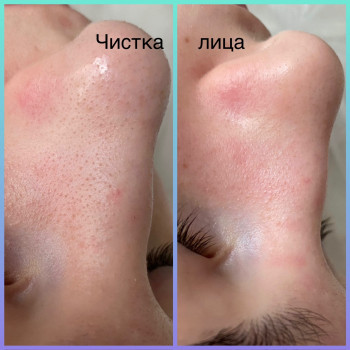 Чистка обличчя