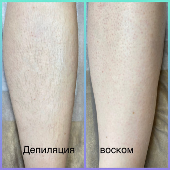 Депіляція гомілок