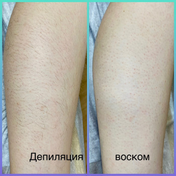 Депіляція гомілок