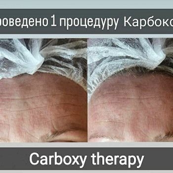 Результат з першої процедури, рогладження, відбілення пігментації, покращення стану шкіри, підвищенгя пружності шкіри.