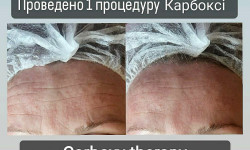 Карбоксітерапія Косметолог Мар'яна Трускавец