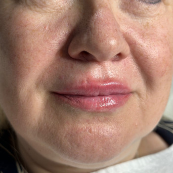 Корекція губ мʼяким філлером Juvederm Volbella