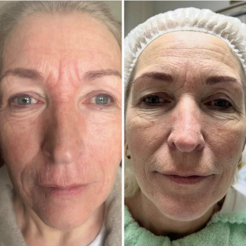 Одноразова апаратна процедура ліфтінг омолодження: Все обличчя Очі кругова Верхня або Нижня повіка Міжбрівка Носогубні заломи Кісетні зморшки Шия «Кільця Венери» Лоб