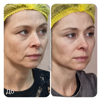 Холодний ліфтінг