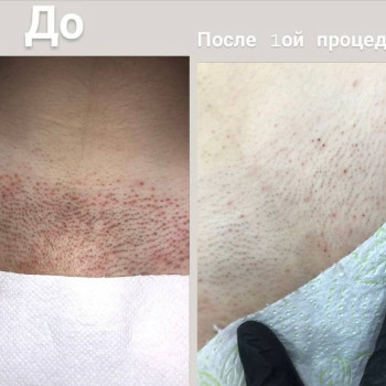 До/Після