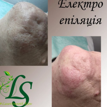 Фото с портфолио LaserSmooth studio