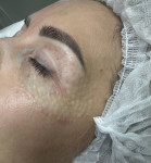Мезотерапія зони навколо очей Косметолог Анастасия Днепр