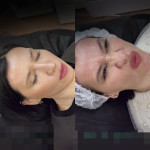 Акція на Ботокс Full face Косметолог-инъекционист Любов Днепр