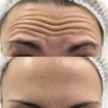 Тетяна Кисельова, KissCosmetology. Ботулінотерапія міжбрів’я: результат до та після процедури. Корекція мімічних зморшок із збереженням природної міміки.