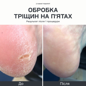 Апаратна обробка тріщин на п’ятах і загрубілої шкіри стоп. На фото стан до та результат після однієї процедури. Після прийому надаються рекомендації щодо домашнього догляду. Подологічний догляд у Кам’янці-Подільському.