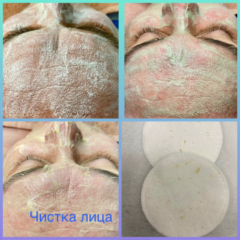 Чистка лица комбинированная