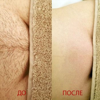 Делікатне видалення небажаного волосся цукровою пастою. Гладкість шкіри та комфорт.