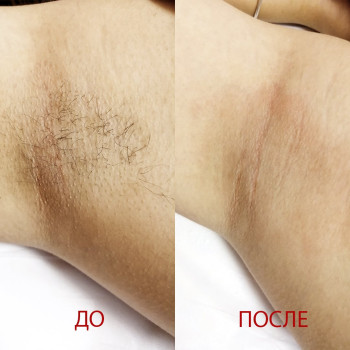 Швидке та делікатне видалення волосся цукровою пастою. Чиста та гладенька шкіра.