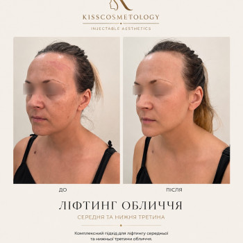 ліфтинг Radiess FullFace