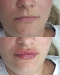 Збільшення губ 1ml Врач-косметолог Олеся Тернополь