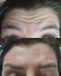 BOTOX  (три зони - знижка) Лікар-косметолог Олеся Тернопіль