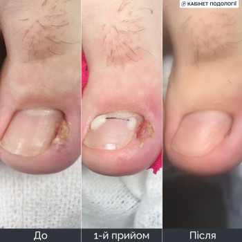 Врослий ніготь: подологічний догляд і корекція нігтьової пластини. На фото — стан до звернення, після першого прийому з корекційною системою та результат після подальшого догляду. Робота з вростанням нігтя у Кам’янці-Подільському, з рекомендаціями щодо домашнього догляду та зменшення ризику повторного вростання