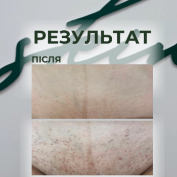 Фото с портфолио Laser Skin