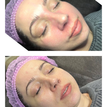 glass skin