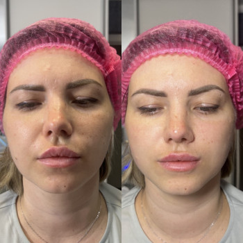 мезотерапія+glass skin