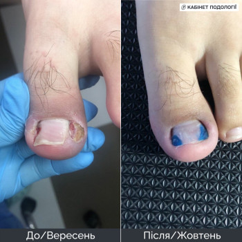 Подологічний догляд за зміненою нігтьовою пластиною. На фото — стан нігтя у вересні та результат догляду в жовтні. Апаратна обробка нігтя, контроль стану нігтьової пластини та рекомендації щодо домашнього догляду. Подолог у Кам’янці-Подільському. Ріпська Олена