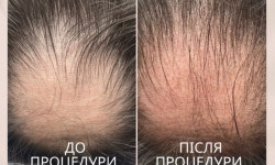 Трихопігментація Мастер татуажа Елена Киев
