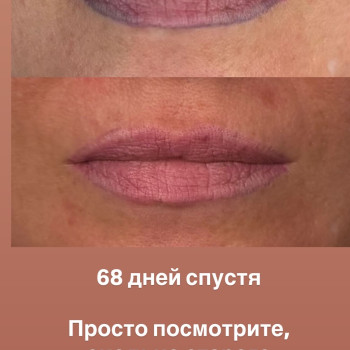 ЛАЗЕРНОЕ УДАЛЕНИЕ ТАТУАЖА