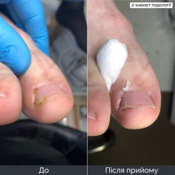 Обробка врослого нігтя та прилеглої ділянки шкіри. На фото стан до та після прийому. Проведено апаратну обробку краю нігтьової пластини та очищення проблемної ділянки для зменшення дискомфорту.