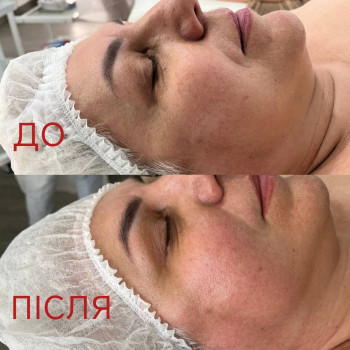 До/Після масажу обличчя Кобідо. результат одного сеансу - більш свіжий та відпочилий вигляд шкіри. масажобличчя масаж шкірою Київ Barbua Oranskabeauty