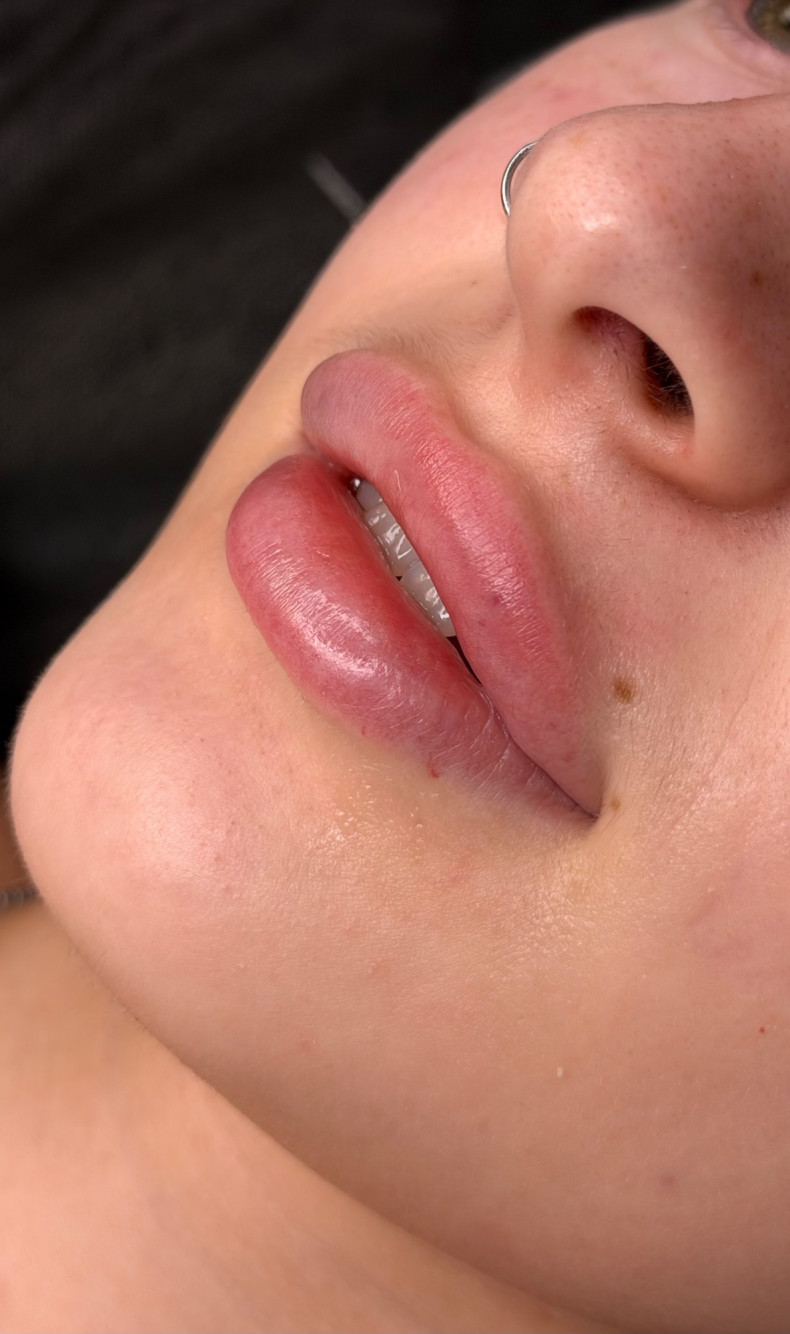 Увеличение губ контурная пластика аугментация, фото - Косметолог-инъекционист Алекс