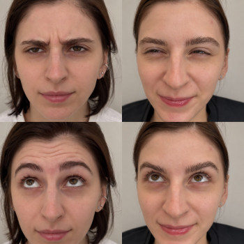 Ботокс