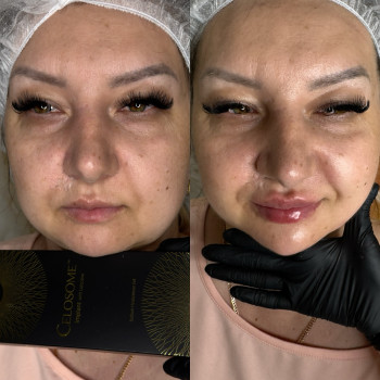 Корекція губ та підборіддя