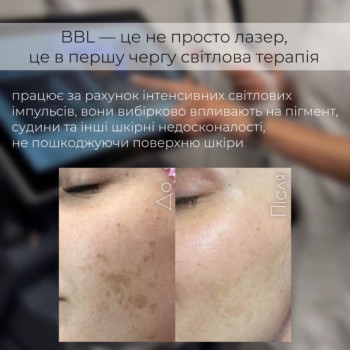 Лазерне лікування шкіри Видалення: Пігментації, куперозу, розацеа, постакне.