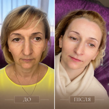 Ліфтинг «7 точок молодості» + ботокс (верхня частина обличчя)
