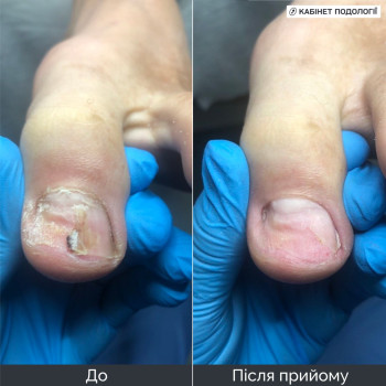 Апаратна обробка травмованої нігтьової пластини. На фото стан нігтя до та після прийому: проведено делікатну зачистку пошкодженої ділянки та очищення нігтьової пластини. Подологічний догляд після травми нігтя з рекомендаціями щодо подальшого домашнього догляду.