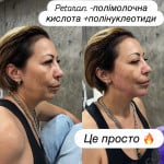Гироксіапатит кальцію (faceteme) Косметолог-ін'єкціоніст Виктория Харків