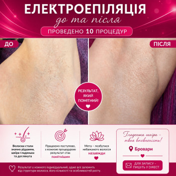 Електроепіляція підмишок — робота майже завершена ✨ Ще трішки — і можна буде назавжди забути про постійне гоління та небажане волосся 🤍 Крок за кроком — до гладенької шкіри 🫶