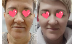Ліфтинг Монако Косметолог Ірина Львов