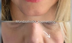 Полімолочна кислота - колагеностимуляція Косметолог-инъекционист Марьяна Фастов
