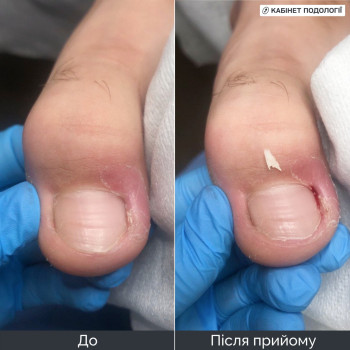 Врослий ніготь: подологічний догляд та апаратна обробка проблемної ділянки. На фото стан до та після прийому. Проведено обробку краю нігтьової пластини та прилеглої шкіри, надано рекомендації щодо домашнього догляду. Подологічний прийом у Кам’янці-Подільському.