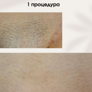 Фото с портфолио Laser For You