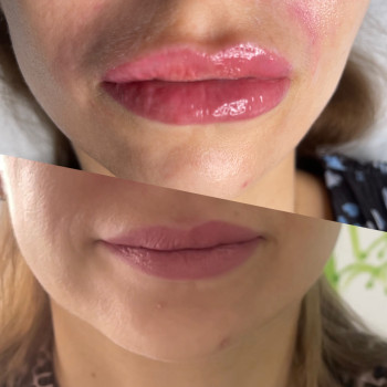 Навіщо ставити філер у вікові губи? 💋 З віком губи не просто втрачають об’єм. Змінюється їхня анатомія: вони стають тоншими, сухішими, втрачають чіткість контуру, а куточки опускаються Тому філер у вікових губах — це не «зробити більші губи». ✨ відновити втрачений об’єм ✨ повернути чіткість контуру ✨ покращити пропорції ✨ зволожити та зробити губи візуально молодшими ✨ підтримати тканини та делікатно скоригувати вікові зміни Моя мета — не змінити ваші губи, а повернути втрачене