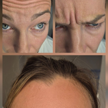 Botox
