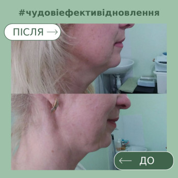 Вікові зміни, жирові пакети і обвисання, зморшки, втрата тургору і еластичності шкіри. За допомогою ін'єкцій ліподітика отримали гарні результати
