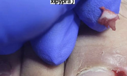 Робота з врослим нігтем при гіпергрануляції Подолог Ольга Дніпро