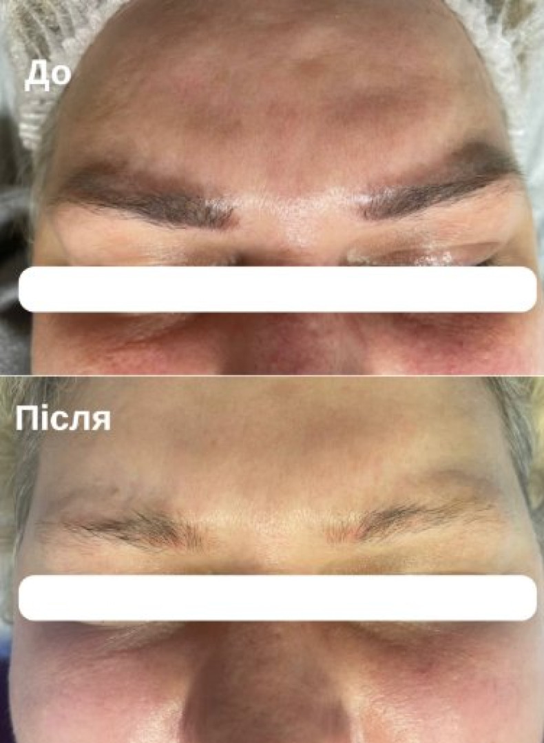 Татуаж бровей удаление татуажа коррекция, фото - Косметология TK Laser