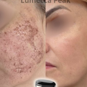 Фото с портфолио Laser Life