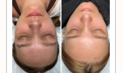 BBL + ВІДНОВЛЕННЯ GENOSIS Косметология YULIA • AESTHETIC MEDICINE Ужгород