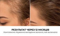 BOOST UP — процедура против выпадения волос Салон краси Мастерская Красоты Юлии Юдиной Київ
